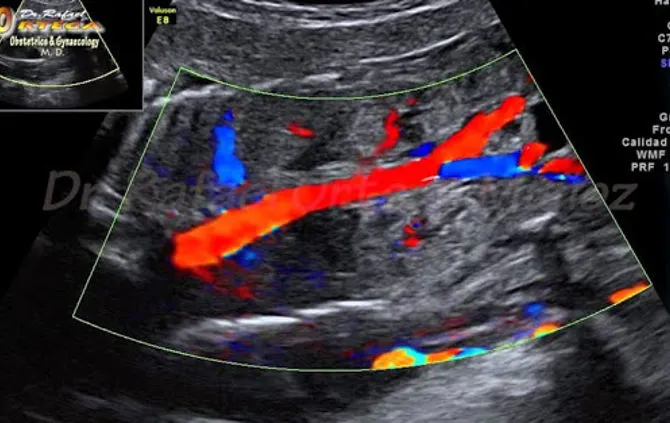 Ecocardiografia colordoppler
